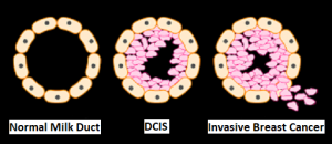 DCIS