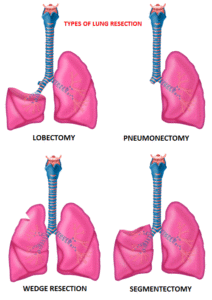 Types-of-Lung-Resection